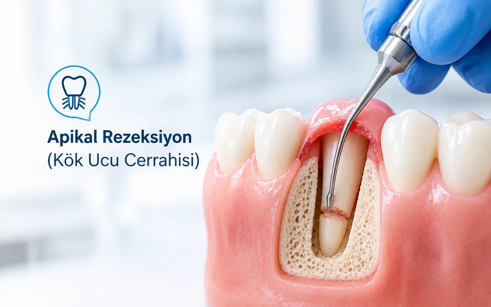 Apikal Rezeksiyon (Kök Ucu Cerrahisi)