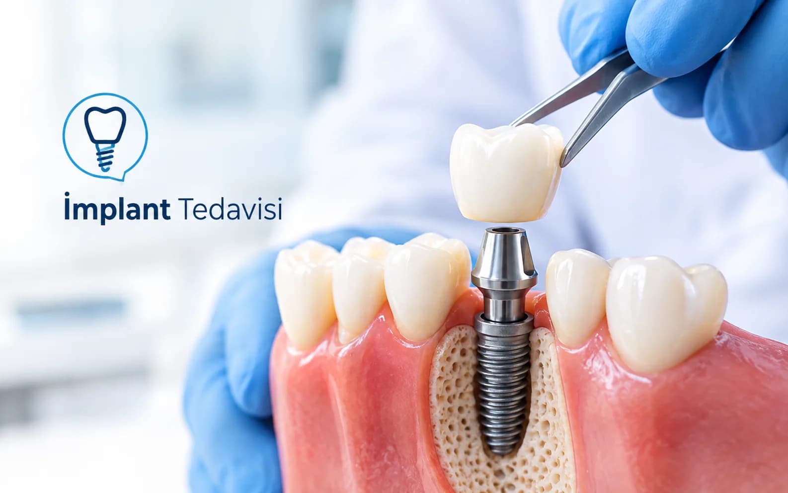 İmplant Tedavisi